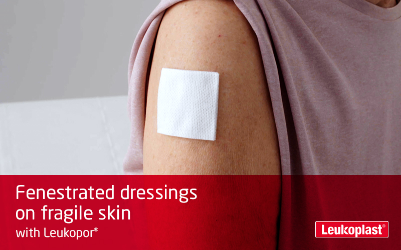 Here we can see in close-up how fenestrated dressings are applied to fragile skin with the help of breathable medical tape: the hands of an HCP are fastening a wound pad to the shoulder of an elderly woman with Leukopor tape. Here we can see in close-up how fenestrated dressings are applied to fragile skin with the help of breathable medical tape: the hands of an HCP are fastening a wound pad to the shoulder of an elderly woman with Leukopor tape.